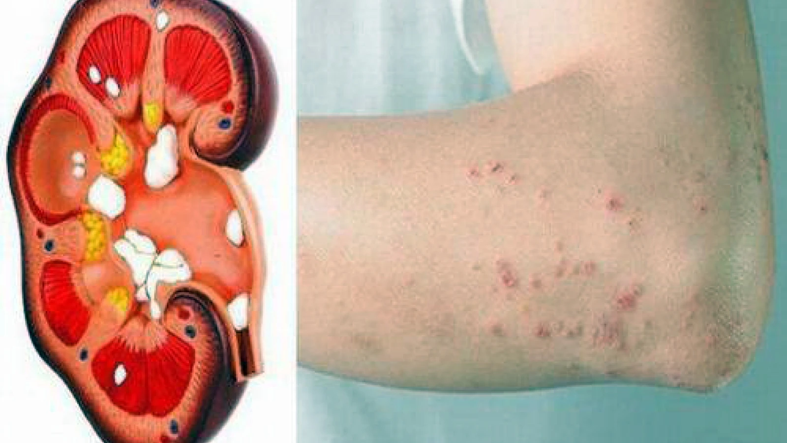Ngứa kéo dài không rõ nguyên nhân: Cảnh báo sớm suy thận